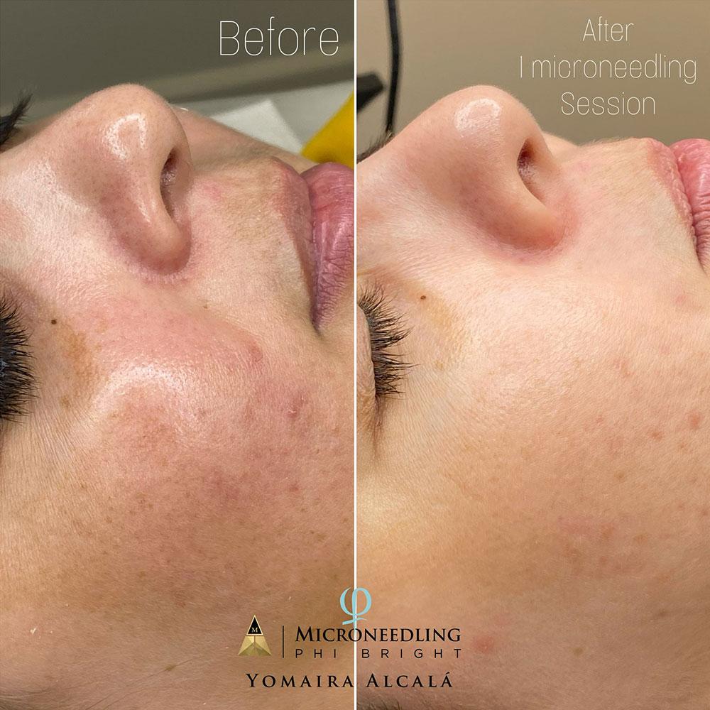 Before After I Microneedling Session