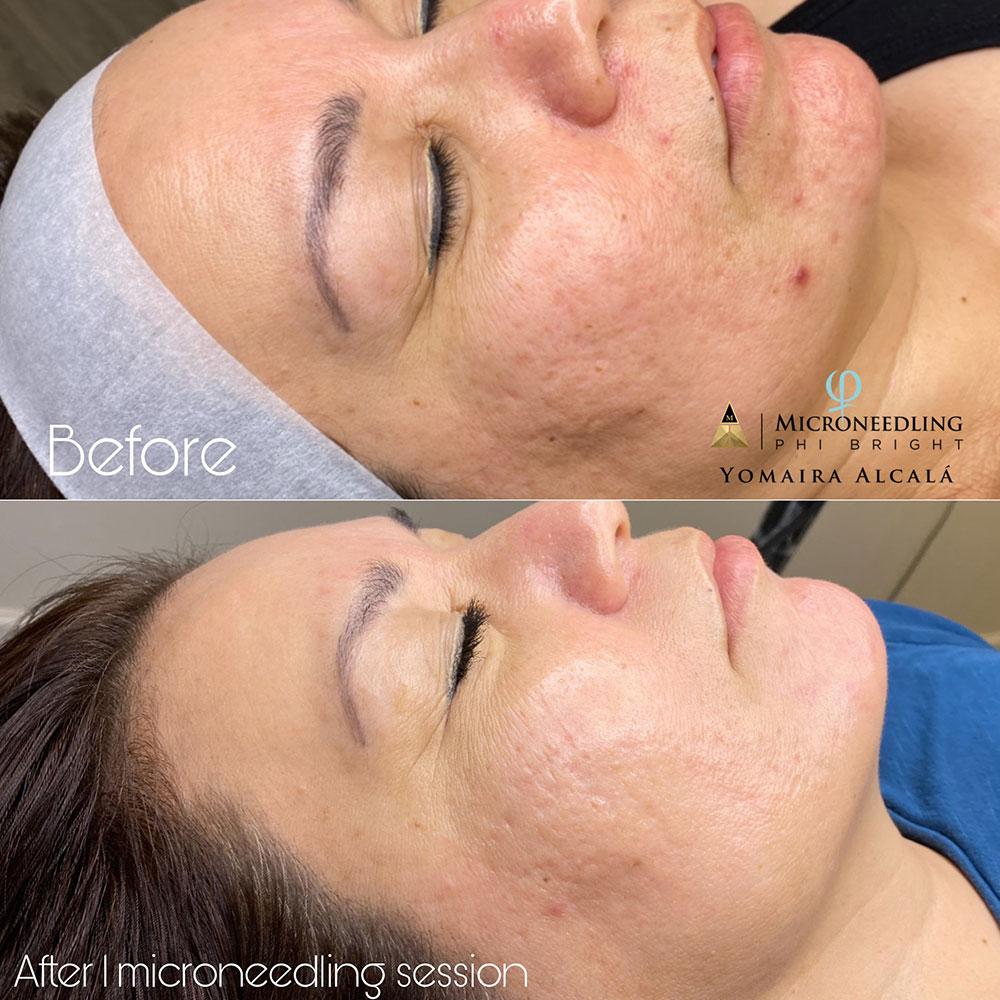 Before After Microneedling Phi Bright